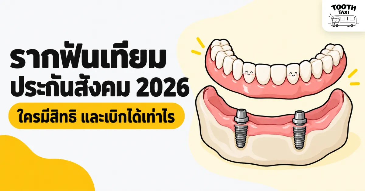 รากฟันเทียมประกันสังคม 2026 สำหรับรองรับฟันเทียมทั้งปาก